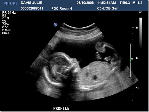 Surprise - Ultrasound3